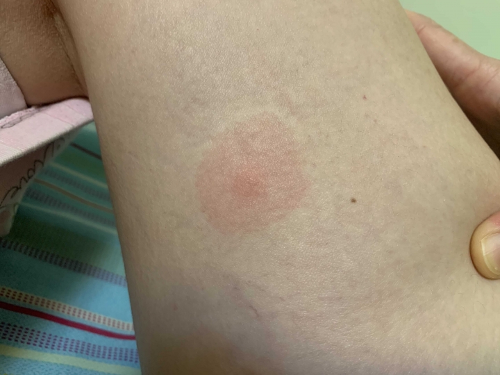 請問這是蟲咬嗎？