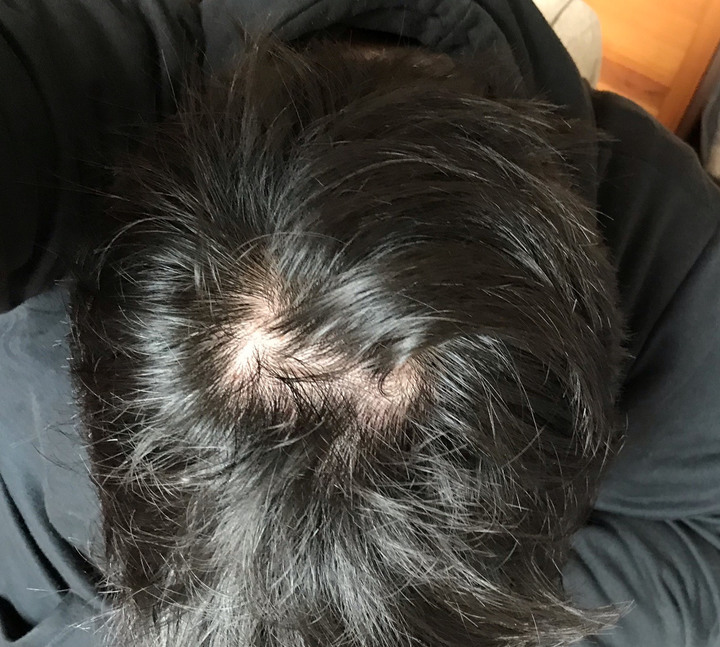 想問一下這個程度的禿頭算是哪一期