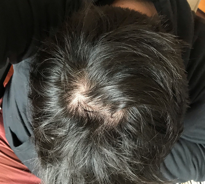 想問一下這個程度的禿頭算是哪一期