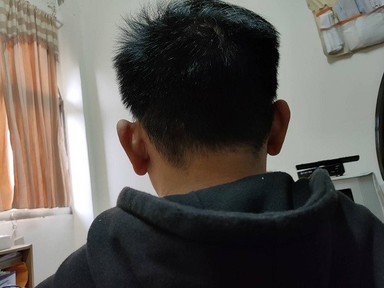 高雄fue額角植髮心得