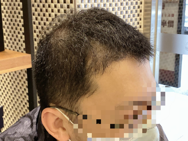 植髮機器人手術來分享啦!!!多圖長文慎入(不喜者勿入