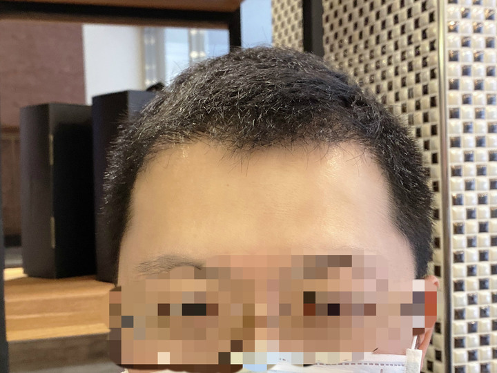 植髮機器人手術來分享啦!!!多圖長文慎入(不喜者勿入