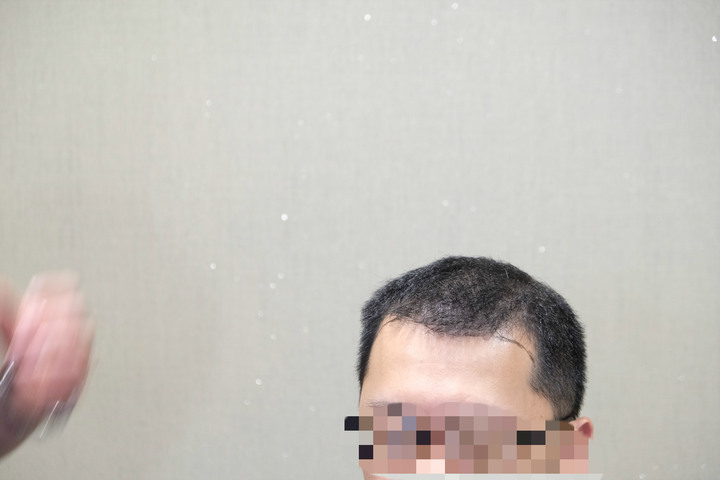 植髮機器人手術來分享啦!!!多圖長文慎入(不喜者勿入