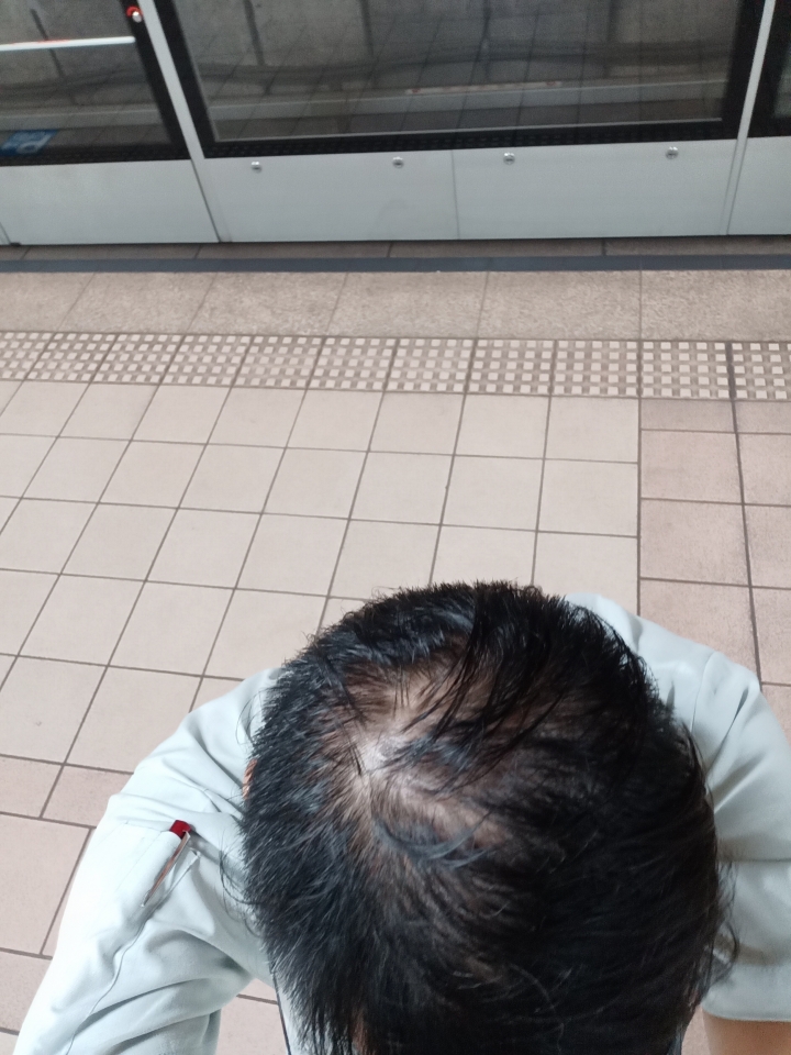 （5分）聽我朋友說 : 如果原本掉的頭髮毛囊萎縮, 再 怎麼植髮都沒有用了, 要早點植 髮, 這是真的假的?