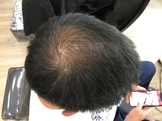 [分享]地中海禿也是可以靠紋髮彌補回來的！