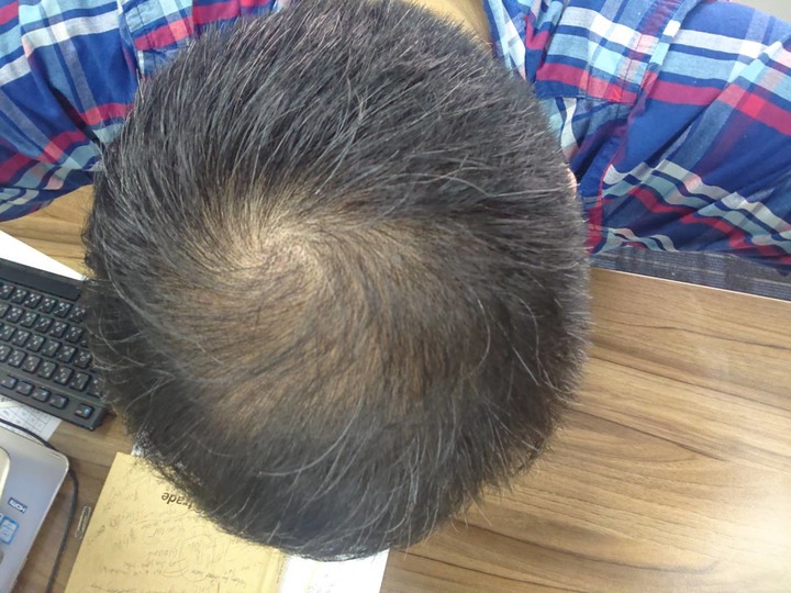irestore生髮帽三個月使用心得效果分享(附照片)