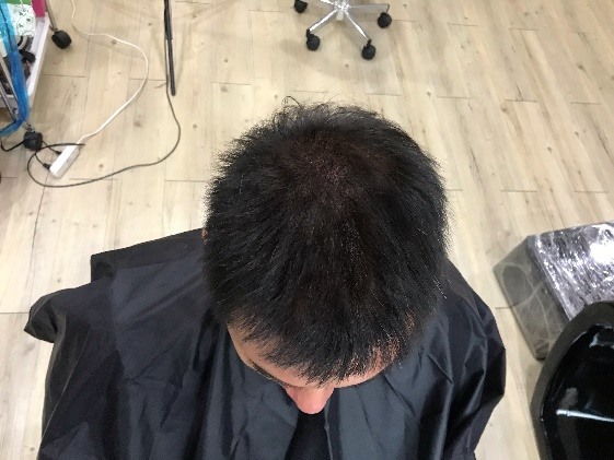 [分享]地中海禿也是可以靠紋髮彌補回來的！