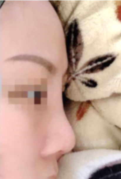 愛美不分年紀 - 猶豫十幾年的隆鼻手術