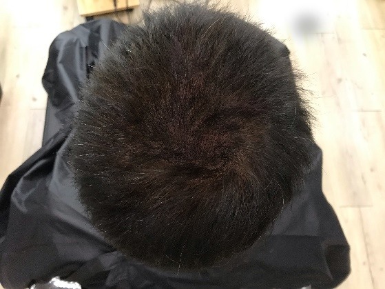 [分享]地中海禿也是可以靠紋髮彌補回來的！