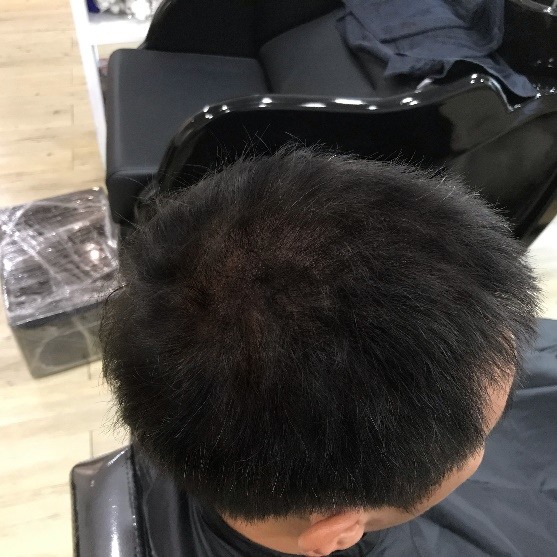 [分享]地中海禿也是可以靠紋髮彌補回來的！