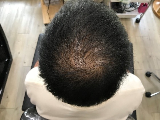 [分享]地中海禿也是可以靠紋髮彌補回來的！