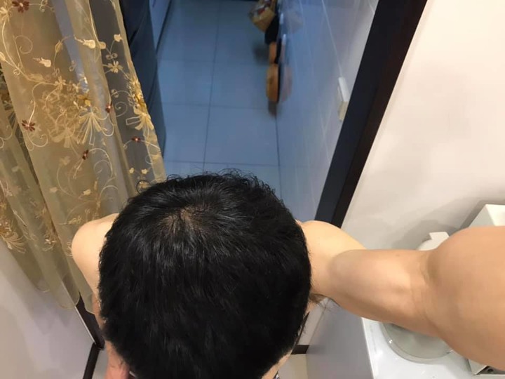 2019.04.26植髮分享
