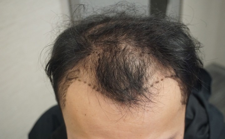 MyHair台北植髮診所，1年術後成果分享