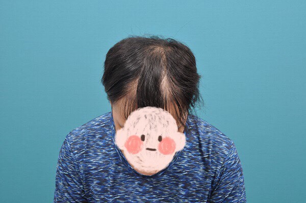 【分享】植了4183根頭髮,人生開始不一樣了!