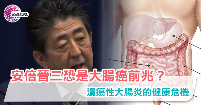 點我看大圖 安倍晉三恐是大腸癌前兆?潰瘍性大腸炎的健康危機