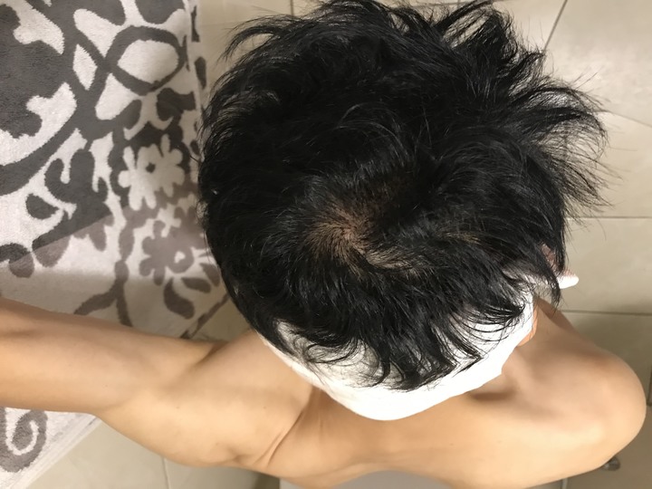 二次植髮，非失敗，只是想更完美