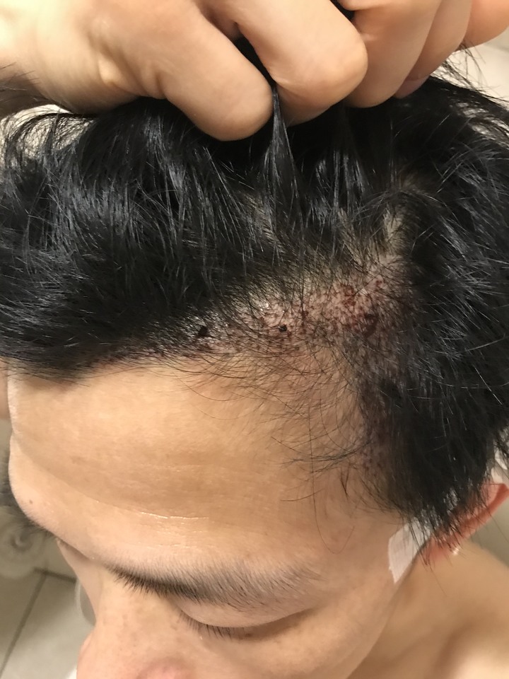二次植髮，非失敗，只是想更完美