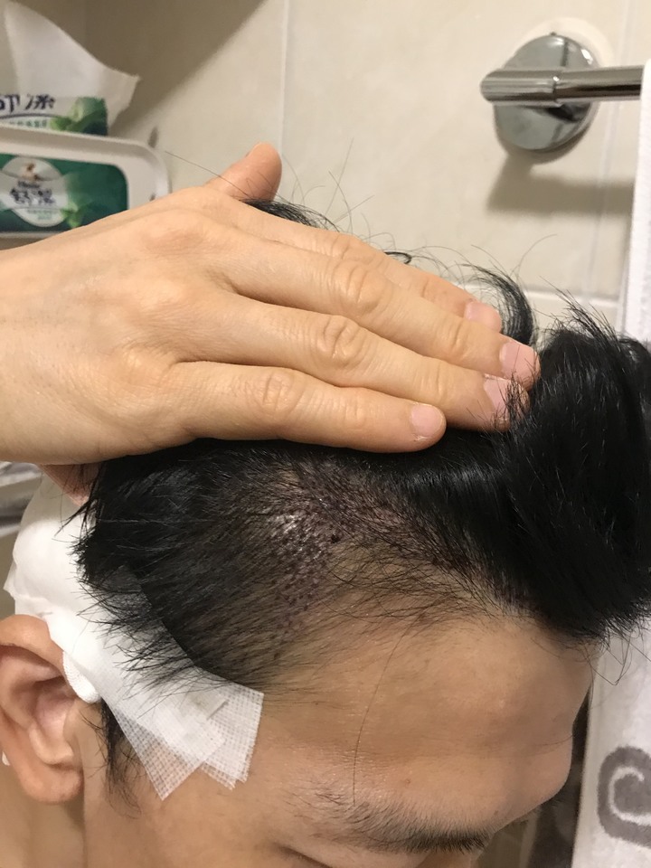 二次植髮，非失敗，只是想更完美