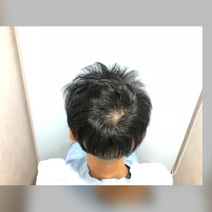 二次植髮，非失敗，只是想更完美