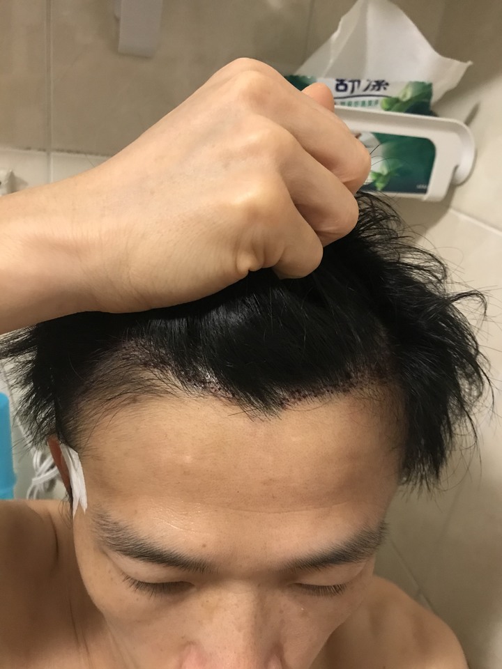 二次植髮，非失敗，只是想更完美