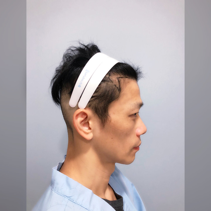 二次植髮，非失敗，只是想更完美