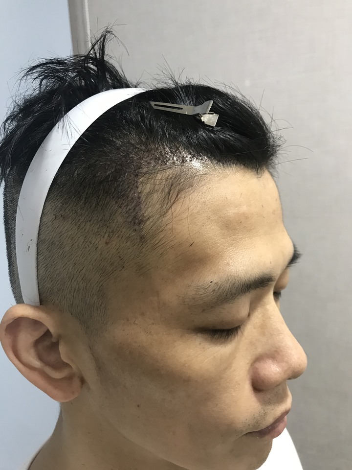 二次植髮，非失敗，只是想更完美
