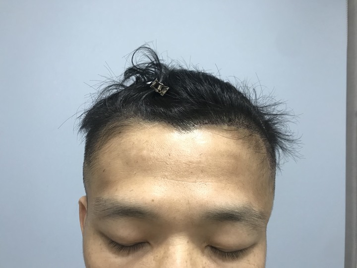 二次植髮，非失敗，只是想更完美