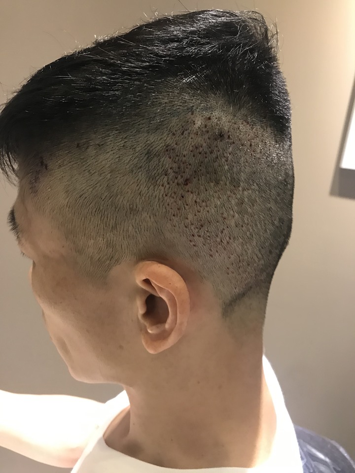 二次植髮，非失敗，只是想更完美