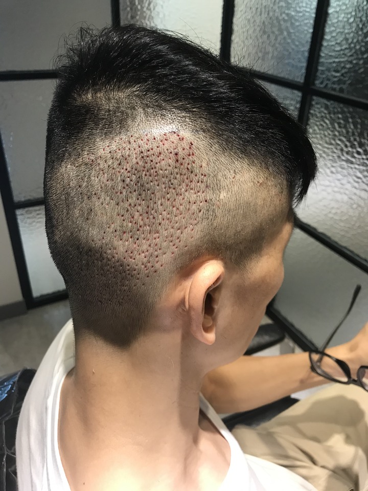 二次植髮，非失敗，只是想更完美