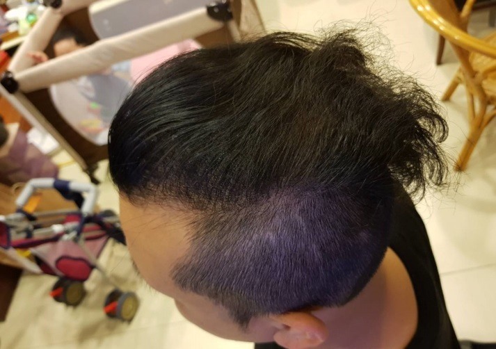 irestore雷射生髮帽八個月使用效果分享