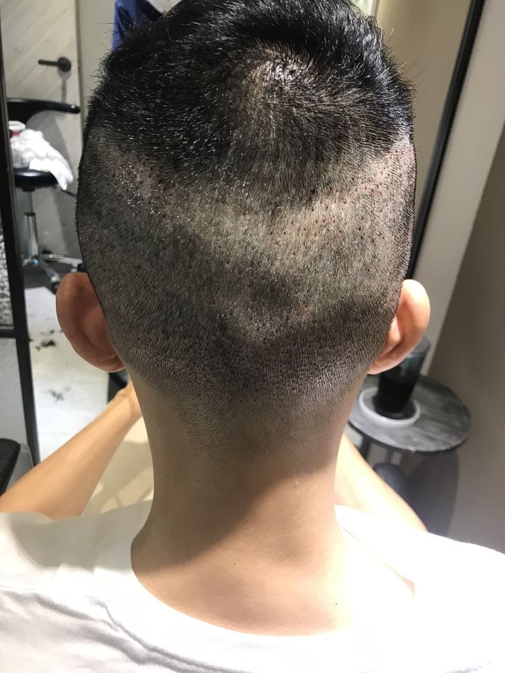 二次植髮，非失敗，只是想更完美