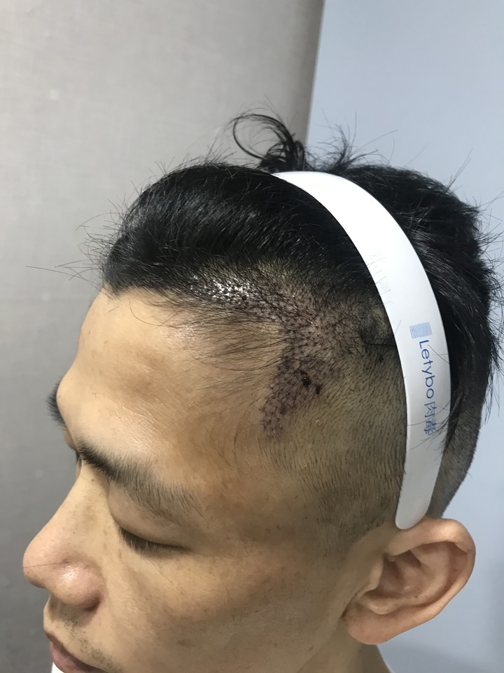 二次植髮，非失敗，只是想更完美