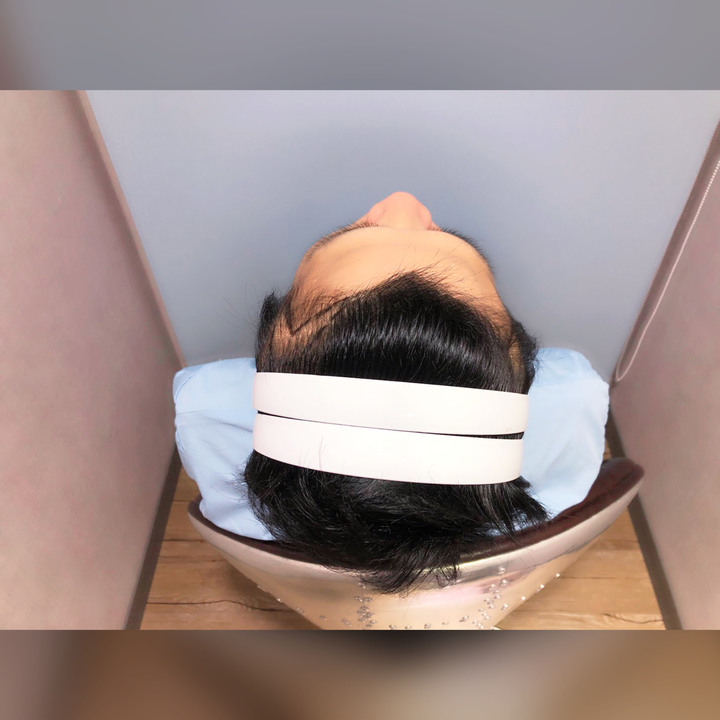 二次植髮，非失敗，只是想更完美