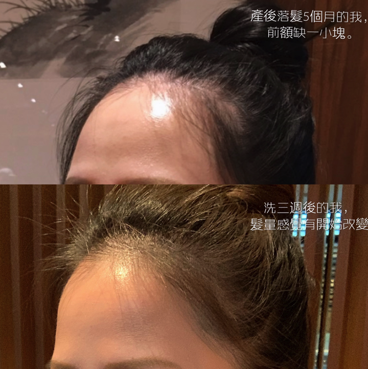 產後我的<蔘>機初體驗,產後落髮的救星