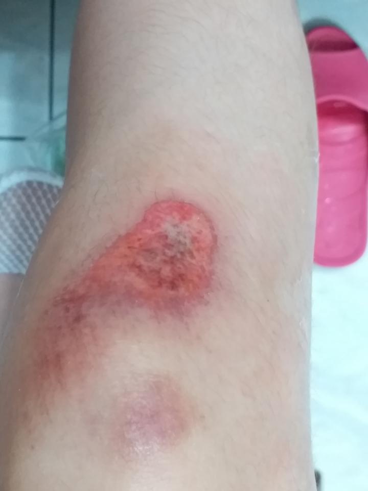 衝刺跌倒傷口問題…