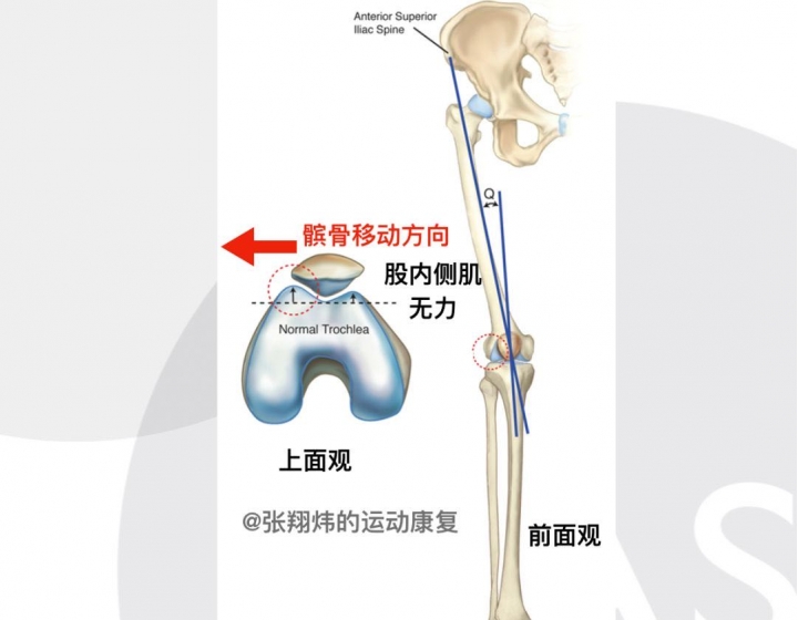 醫院沒講的膝痛必做康復訓練-股內側肌 。