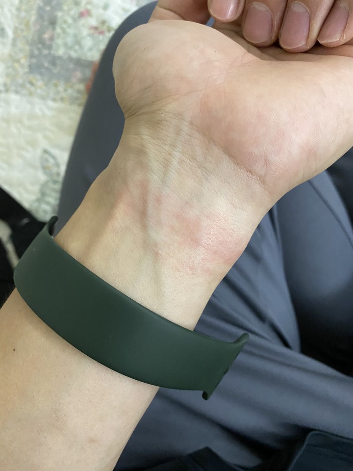 對Apple Watch單圈矽膠過敏