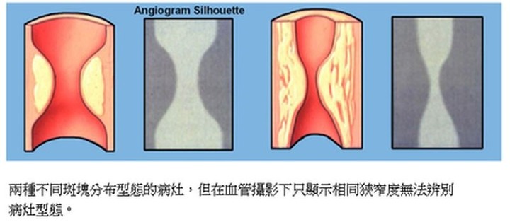 心導管手術的神隊友血管內超音波檢查