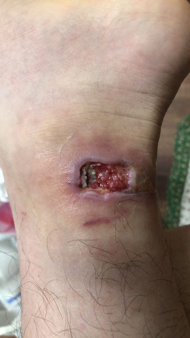 腳踝 車禍傷口那白白的是什麼 是好是壞［附圖］