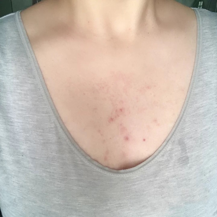 改善胸前痘痘的好物分享