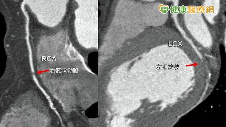 定期檢測遠離心因性猝死低劑量電腦斷層立大功