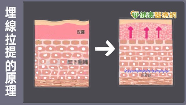 埋線拉提效果驚人？整形權威醫師蘇育台: 雙下巴、嘴邊肉有救！