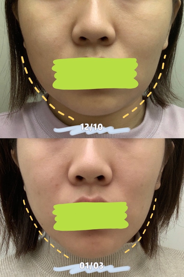 開箱試用最近很火的IDAZ的V臉面膜