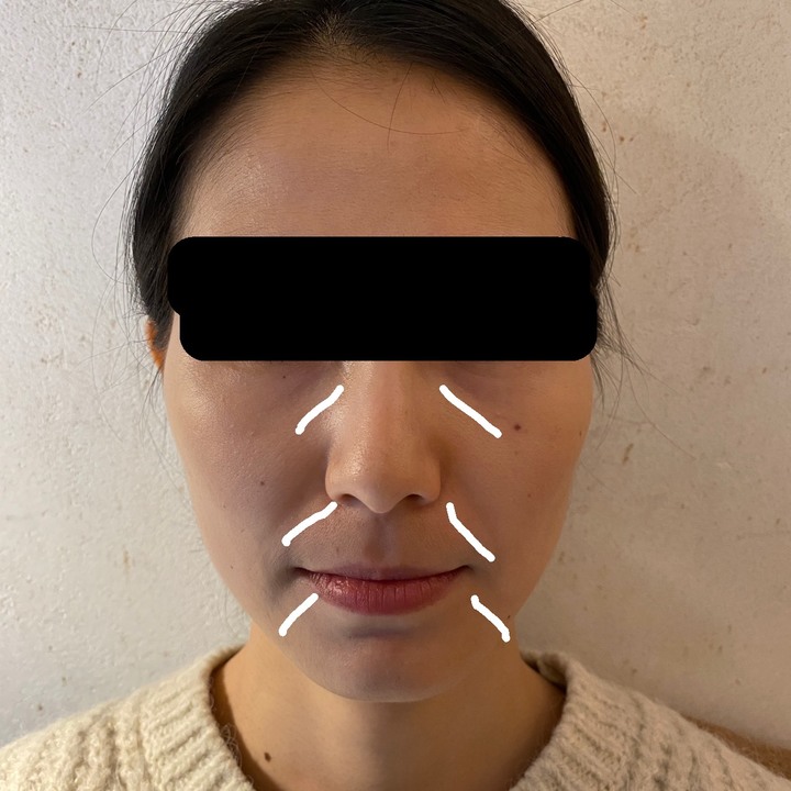 法令紋打玻尿酸心得分享