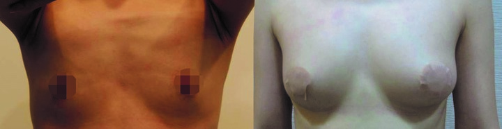 赴韓隆乳計畫泡湯 分享國內隆乳A轉C