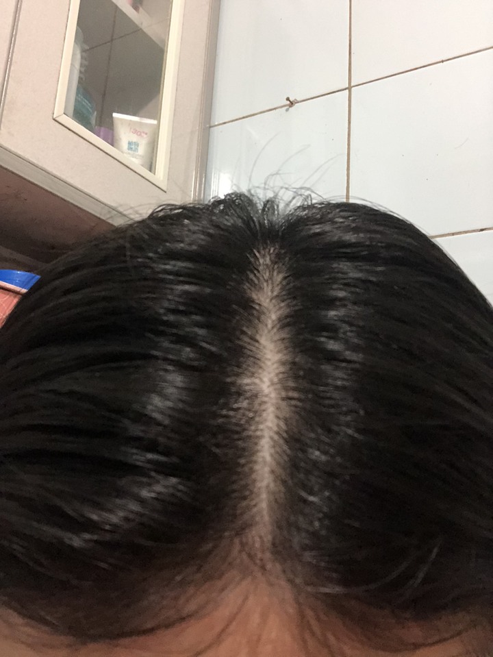 油頭皮去角質一個月心得