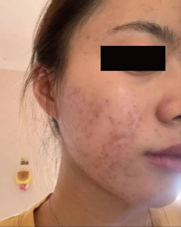 男友海歸嫌我臉爛疑似要分手