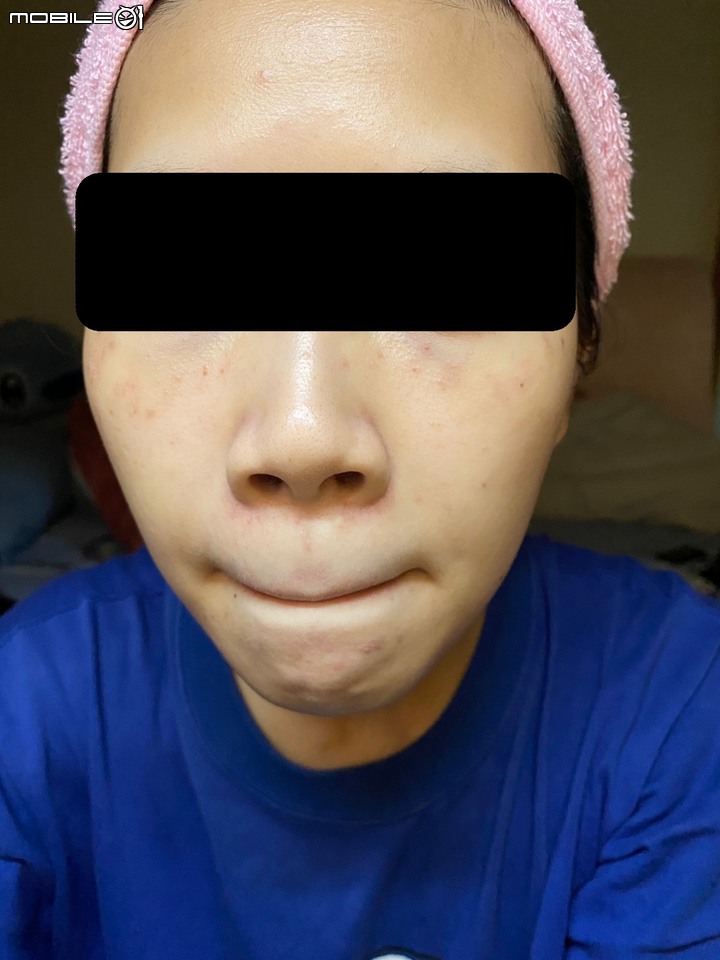 打完皮秒雷射的保濕心得分享