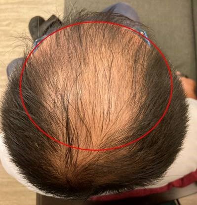 PLT讓我的禿頭不再光溜溜的
