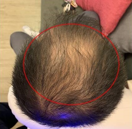 PLT讓我的禿頭不再光溜溜的